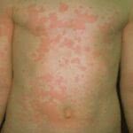 alergias-de-pele-6-150x150