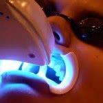 Clareamento Dental a Laser - Preço