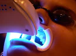 clareamento-dental-a-laser
