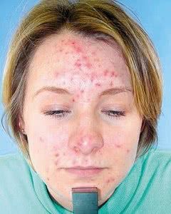 espinhas-acne-tratamento-causa-prevenção-240x300
