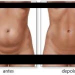 Abdominoplastia Cicatriz