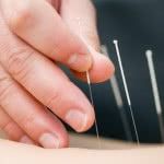 Curso de Acupuntura gratuito