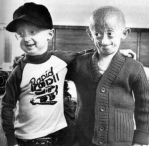 sindrome-de-progeria-300x294