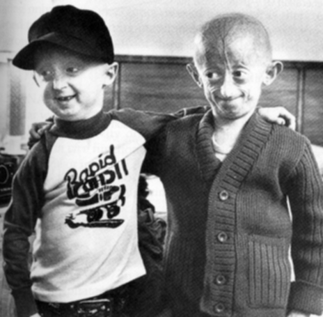 sindrome-de-progeria