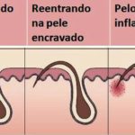 Como remover pelos encravados