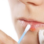 Herpes - Sintomas, Tratamento, Remédios