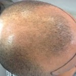 Micropigmentação Capilar - Como Funciona, Preço, Curso
