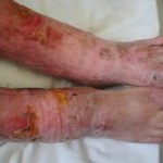 Epidermólise bolhosa - Tratamento, Tem cura?