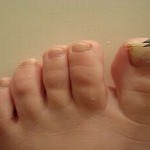 Micose nas unhas - Tratamento, Causas